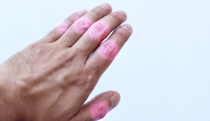 A man's hand with pink marks on it.